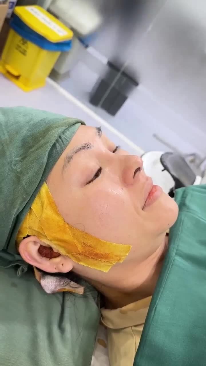 KẾT QUẢ SAU 60 PHÚT NÂNG MŨI CẤU TRÚC DR. HOẠT KH. DIỄM HƯƠNG (VIỆT KIỀU MỸ)