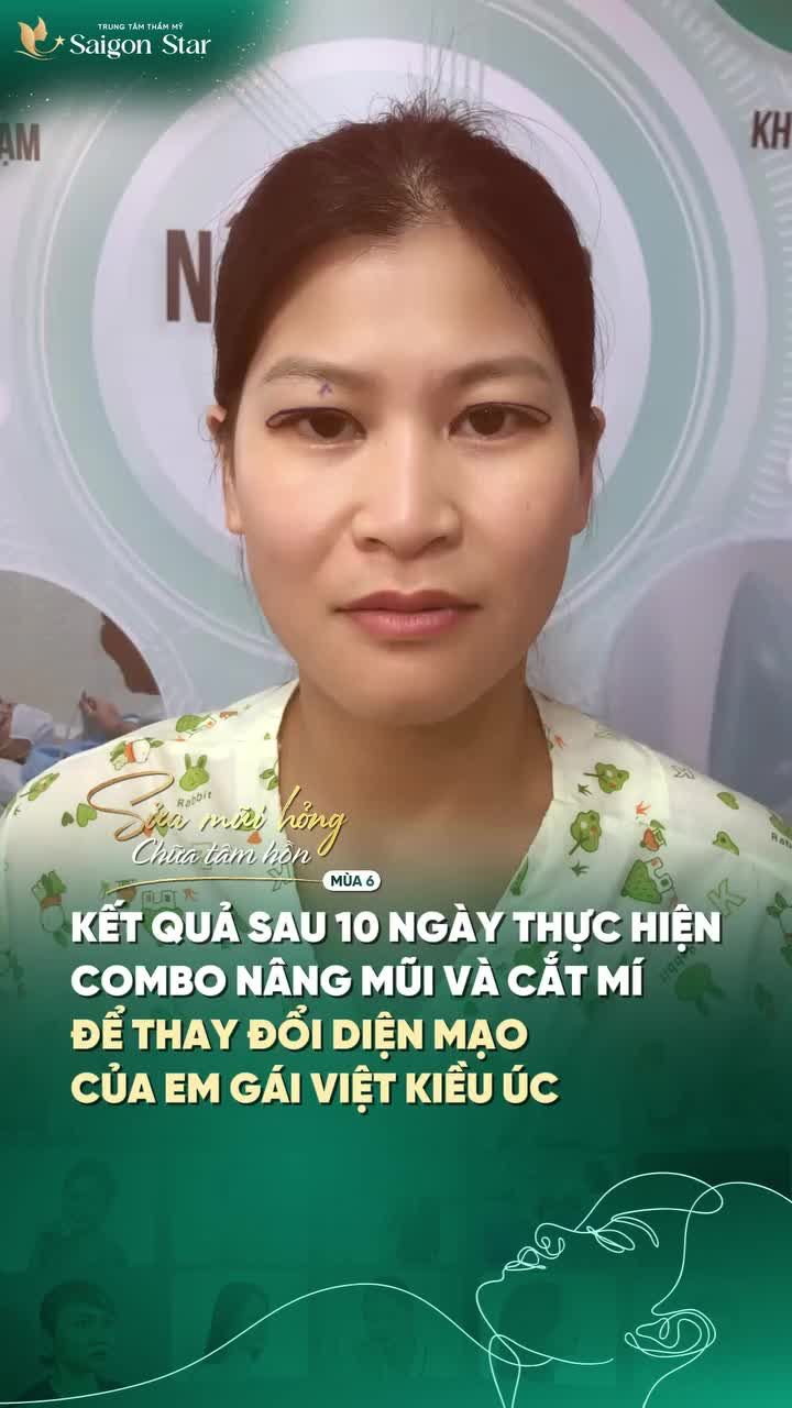 SAU 10 NGÀY SỬA LẠI MŨI HỎNG, CHỊ KHÁCH KHÔNG NHÌN RA CHÍNH MÌNH!!!