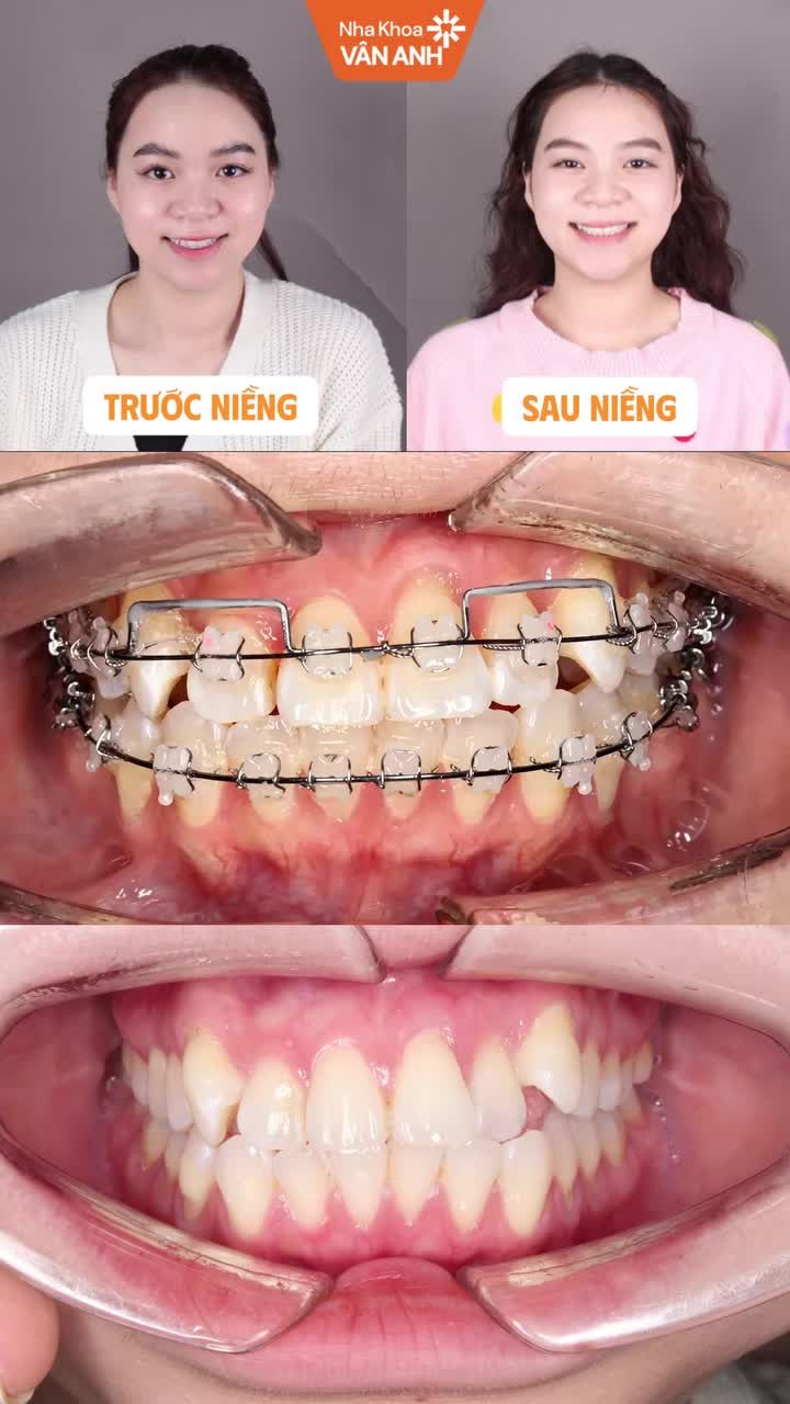 Tóm tắt hơn 2 năm niềng răng chỉ trong 15 giây, hãy xem niềng răng mang đến thay đổi thế nào!