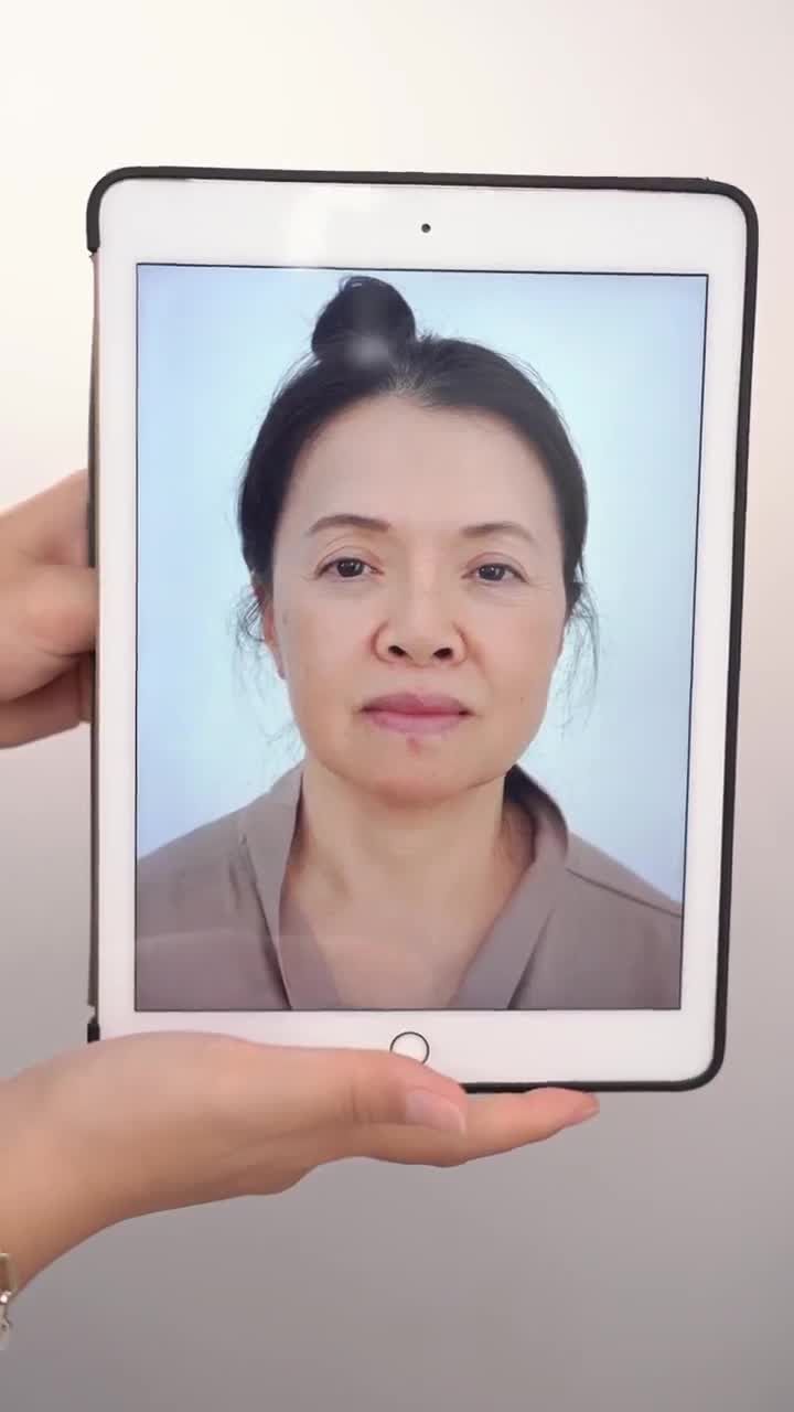 KẾT QUẢ NÂNG MŨI CẤU TRÚC SỬA LẠI CHO KHÁCH HÀNG U70