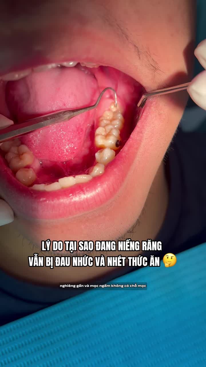 Tại sao khi niềng răng mà có nhiều trường hợp vẫn cảm thấy đau nhức và thường xuyên bị nhét thức ăn?
