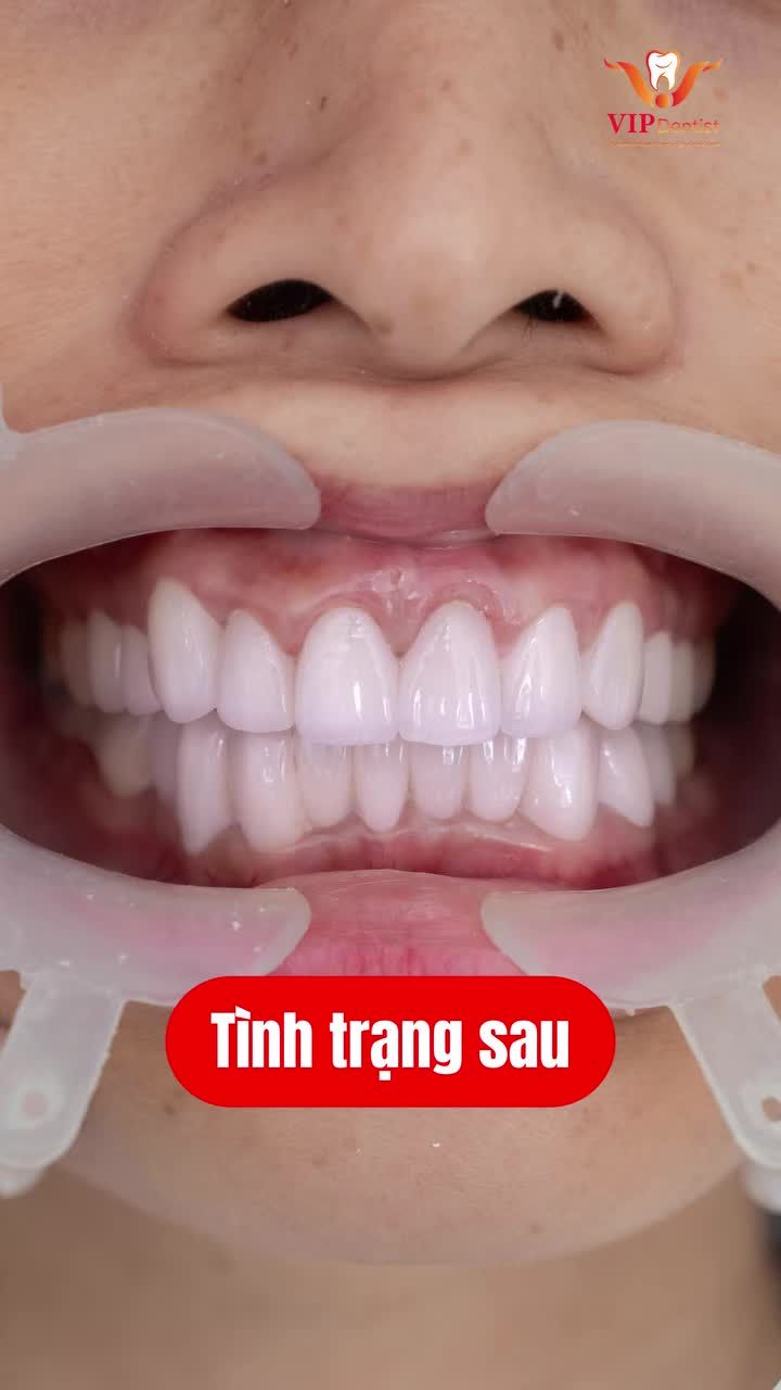 CHỈ 48H – TẠM BIỆT TỰ TI, ĐÓN NỤ CƯỜI MỚI RẠNG RỠ!