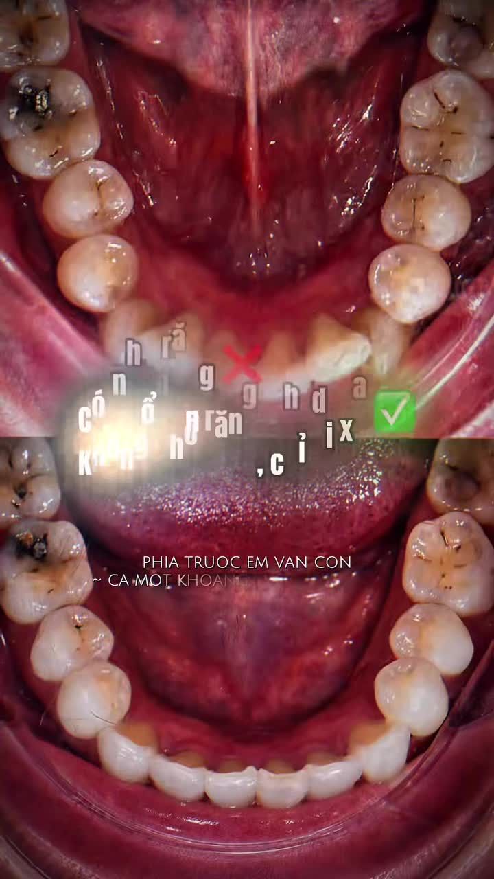 Từ chen chúc ➝ đều đẹp tự nhiên chỉ với Invisalign