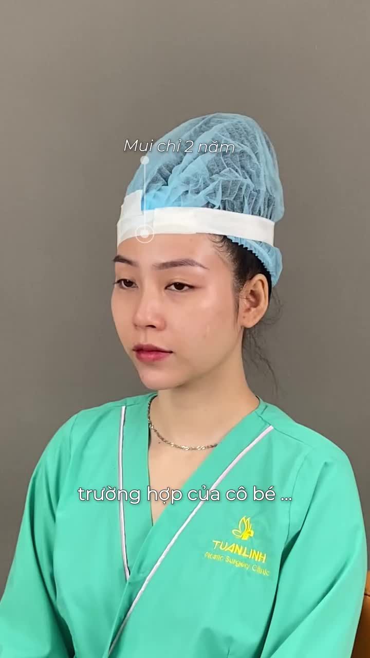 TỪNG TIÊM FILLER – NÂNG MŨI CHỈ NHƯNG VẪN KHÔNG ƯNG Ý… VÀ CÁI KẾT SAU KHI PHẪU THUẬT NÂNG MŨI