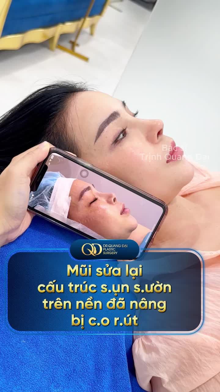MŨI SỬA LẠI CẤU TRÚC SỤN SƯỜN TRÊN NỀN ĐÃ NÂNG BỊ CO RÚT