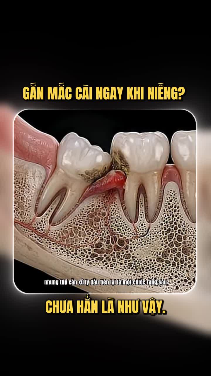 KHÔNG HIỂU VỀ RĂNG KHÔN SẼ NGUY HIỂM THẾ NÀO