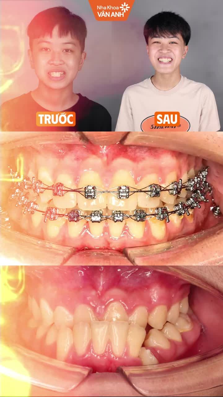 Niềng răng đúng thời điểm, tặng con nụ cười tự tin ngay hôm nay!