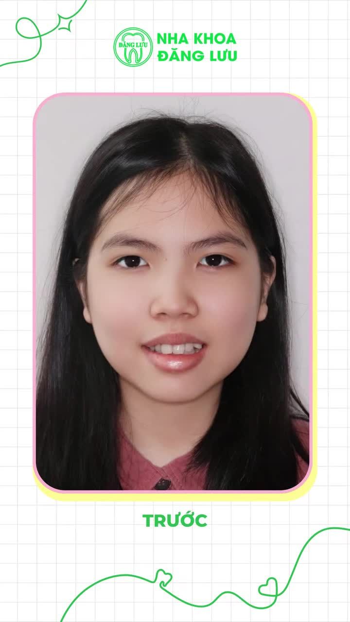 2 NĂM 9 THÁNG NIỀNG RĂNG INVISALIGN - TỪNG BƯỚC TÌM LẠI NỤ CƯỜI TỰ TIN