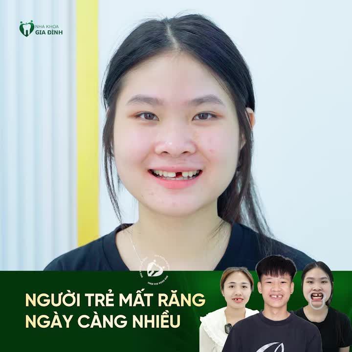 NGÀY CÀNG NHIỀU NGƯỜI TRẺ MẤT RĂNG GIẢI PHÁP HIỆU QUẢ NHẤT CHÍNH LÀ TRỒNG RĂNG IMPLANT