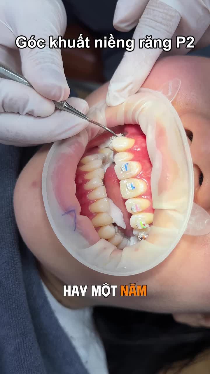Góc khuất niềng răng... Đón xem các góc khuất khác tại kênh Tiktok @bsdophuongchinhnha