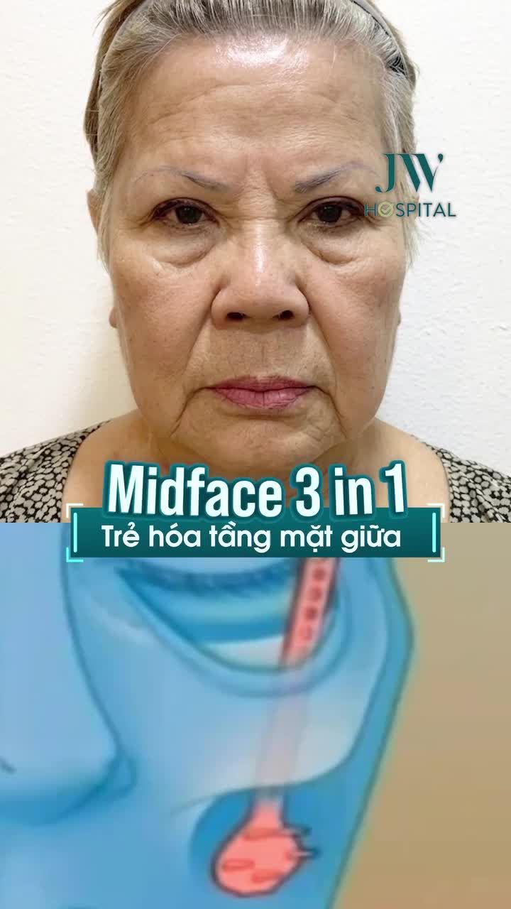 TOP 5 VIỆT KIỀU HỒI HƯƠNG CĂNG DA, NÂNG CƠ TRẺ 20 TUỔI VỚI MIDFACE 3 IN 1 TẠI JW