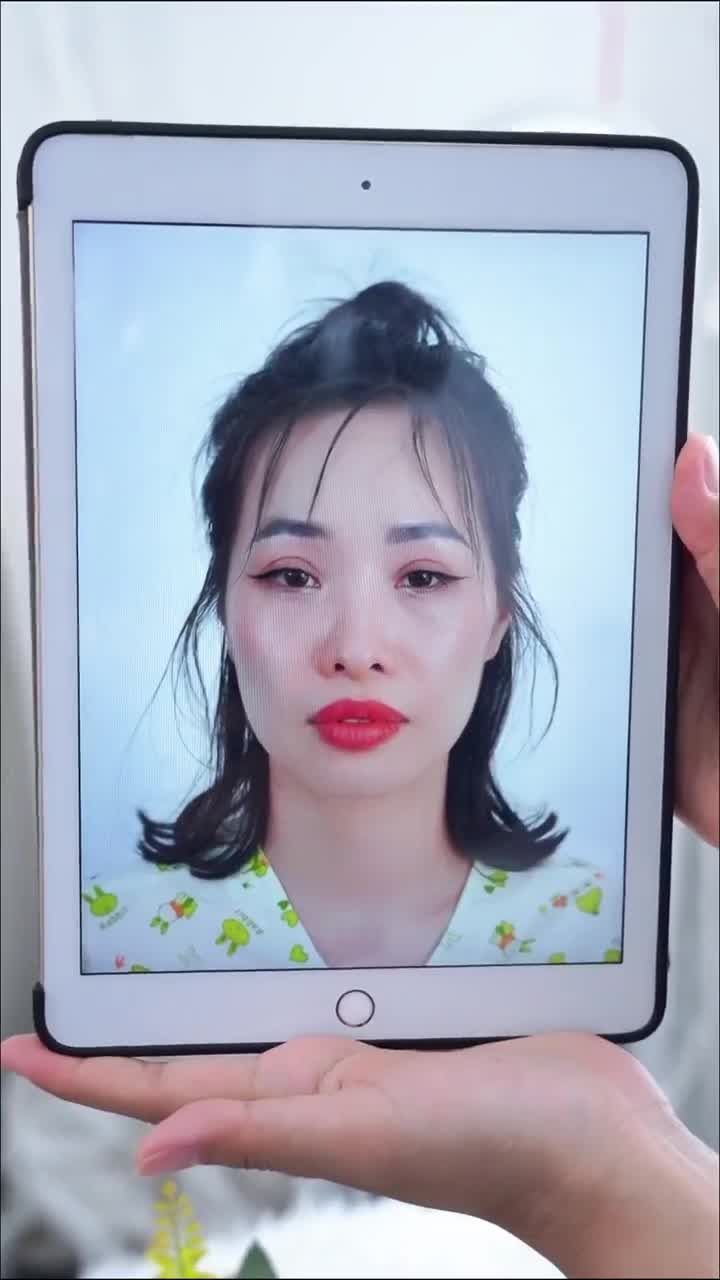 TRẢ KẾT QUẢ SAU 11 NGÀY NÂNG MŨI CẤU TRÚC DR. HOẠT KH. CAO T. PHƯƠNG (ĐỒNG NAI)