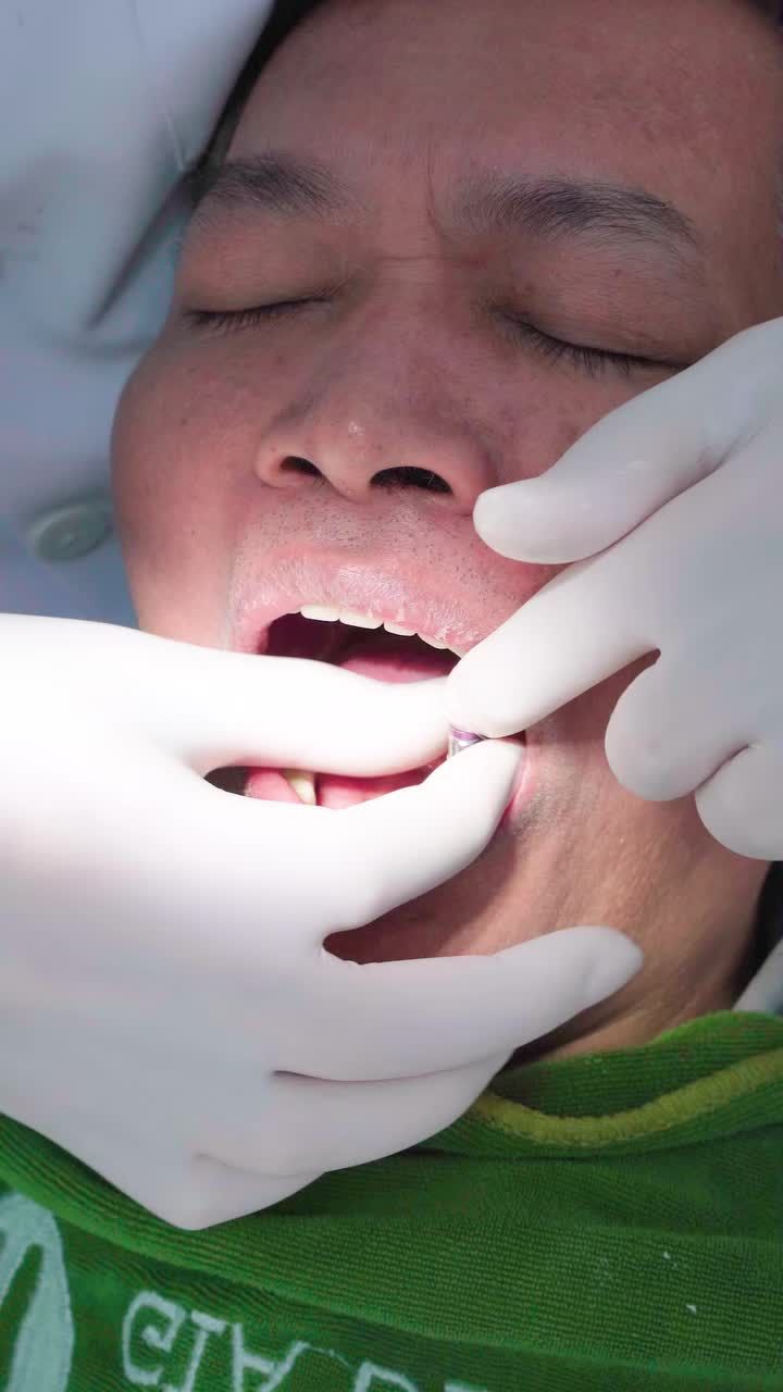 CẬN CẢNH QUÁ TRÌNH LẮP RĂNG TRÊN IMPLANT CHO KHÁCH HÀNG