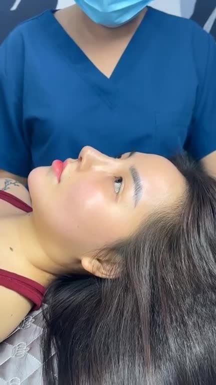MŨI CẤU TRÚC SURGIFORM RÚT CHỈ 9 NGÀY