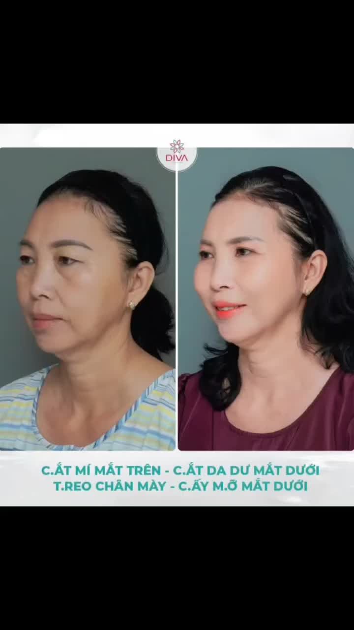 THẦN THÁI TƯƠI TẮN, TRẺ TRUNG HƠN SAU KHI CẮT MÍ, TREO CHÂN MÀY, CẮT DA DƯ MẮT DƯỚI, CẤY MỠ VÙNG MẮT DƯỚI, B.OTOX ĐUÔI MẮT!
