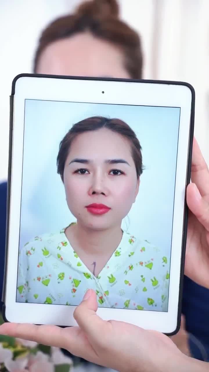 KHOE CẬN DÁNG MŨI SAU 10 NGÀY SỬA LẠI MŨI HỎNG KH. HỒNG CHÂU  (BẾN TRE)