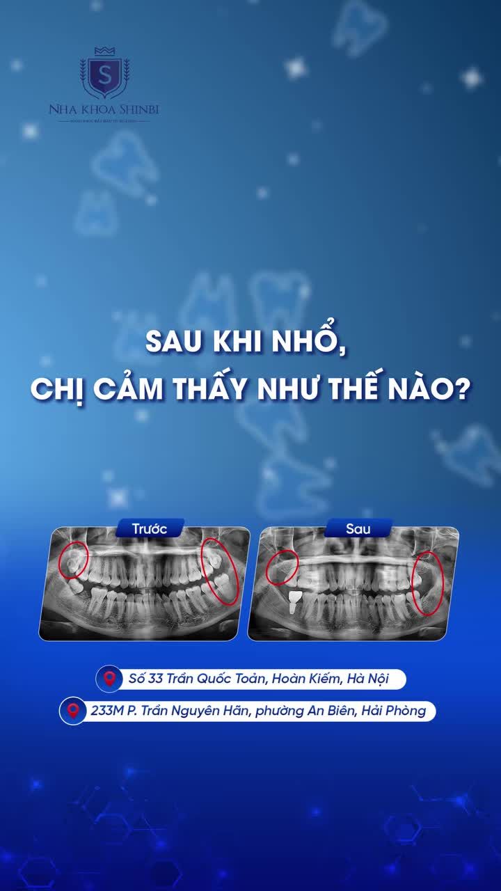 NHỔ RĂNG KHÔN NHẸ TÊNH - KHÔNG ĐAU, KHÔNG SƯNG CÙNG NHA KHOA SHINBI!
