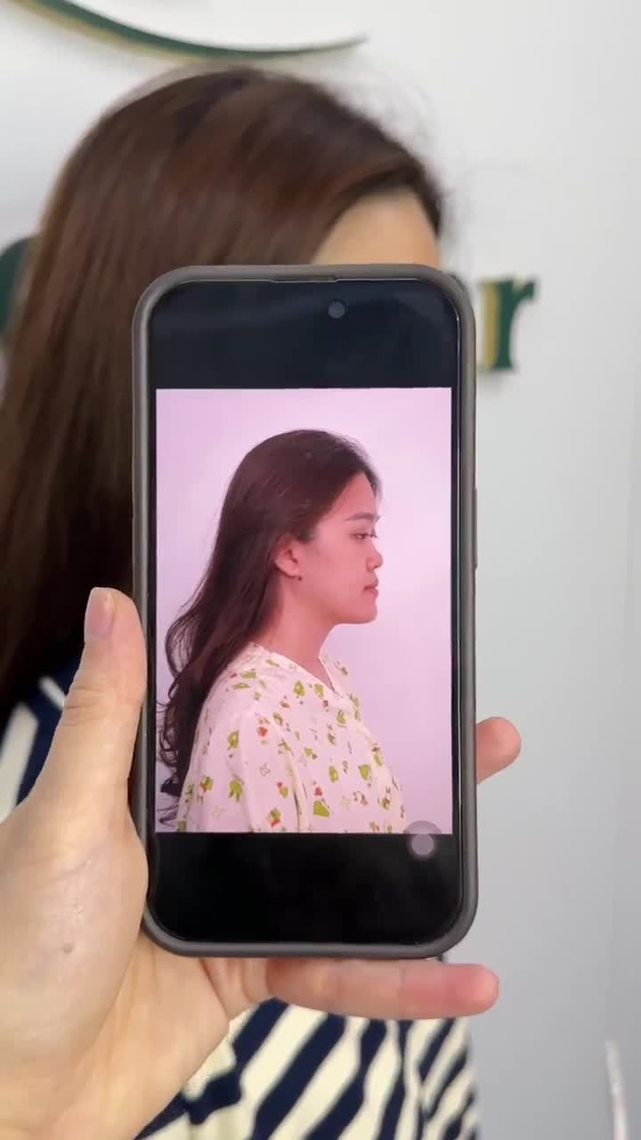 KẾT QUẢ NÂNG MŨI CẤU TRÚC SAU 10 NGÀY KH. GIA HÂN