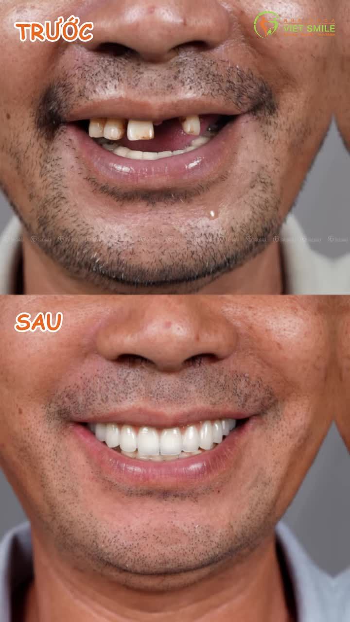 Khó ăn nhai? Cười không tự tin? - Có trồng răng Implant, xóa bỏ tự ti, răng chắc khỏe thoải mái ăn nhai
