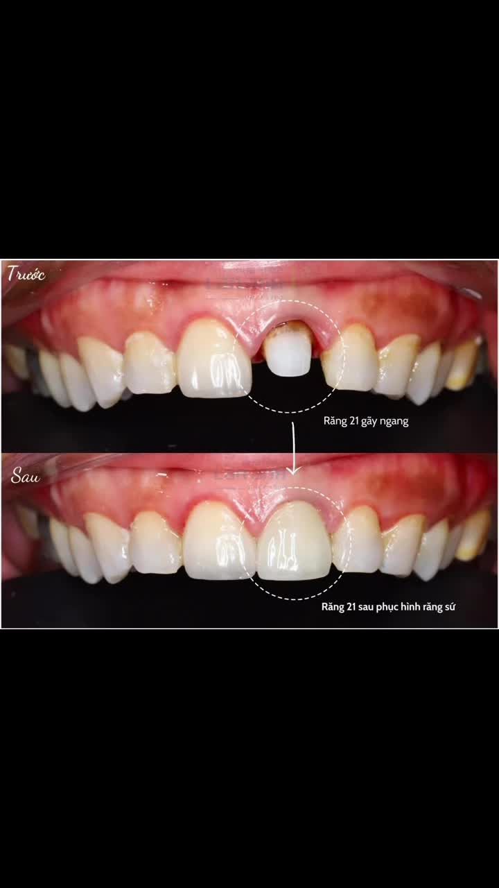 Răng 21 trước đây “ẩn thân” hơi kỹ… Giờ đã comeback đầy tự tin rồi nha