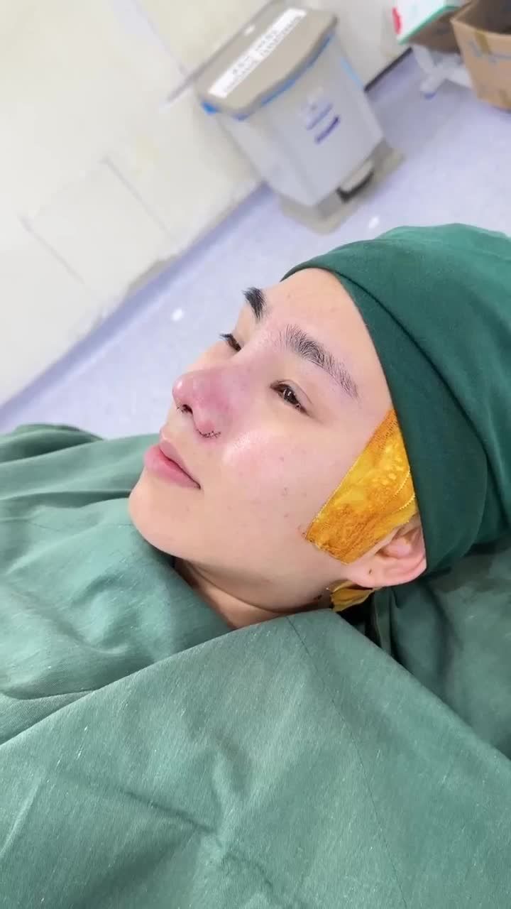 KẾT QUẢ SAU 60 PHÚT NÂNG MŨI CẤU TRÚC DR. HOẠT