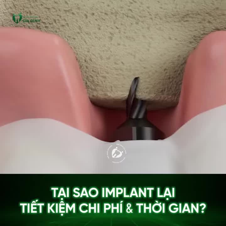 TẠI SAO TRỒNG RĂNG IMPLANT TIẾT KIỆM THỜI GIAN VÀ CHI PHÍ