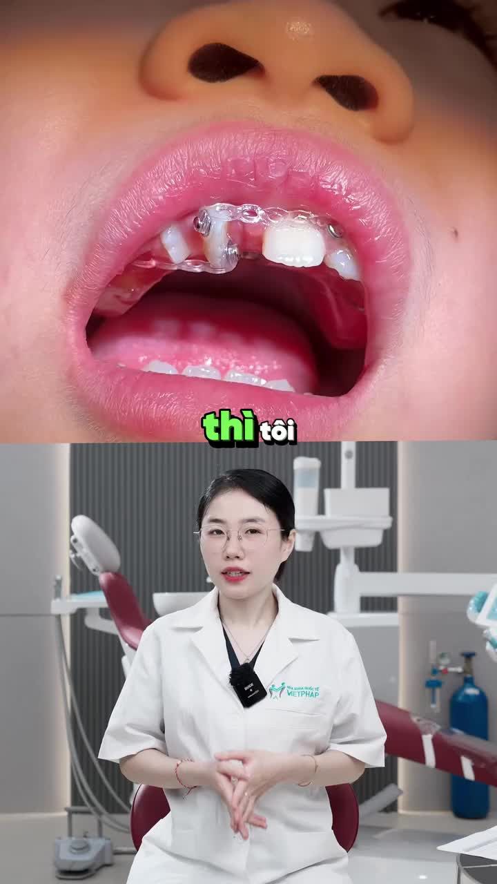 VÌ SAO NÊN CHO CON TIỀN CHỈNH NHA SỚM?