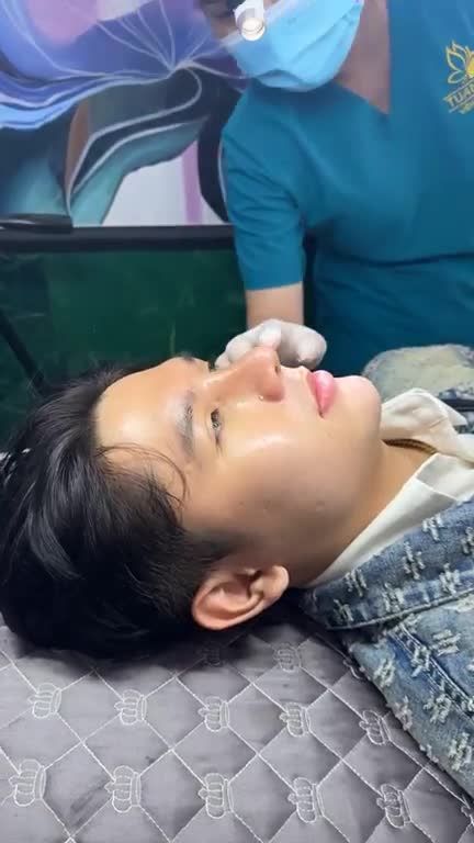 MŨI CẤU TRÚC NAM 10 NGÀY