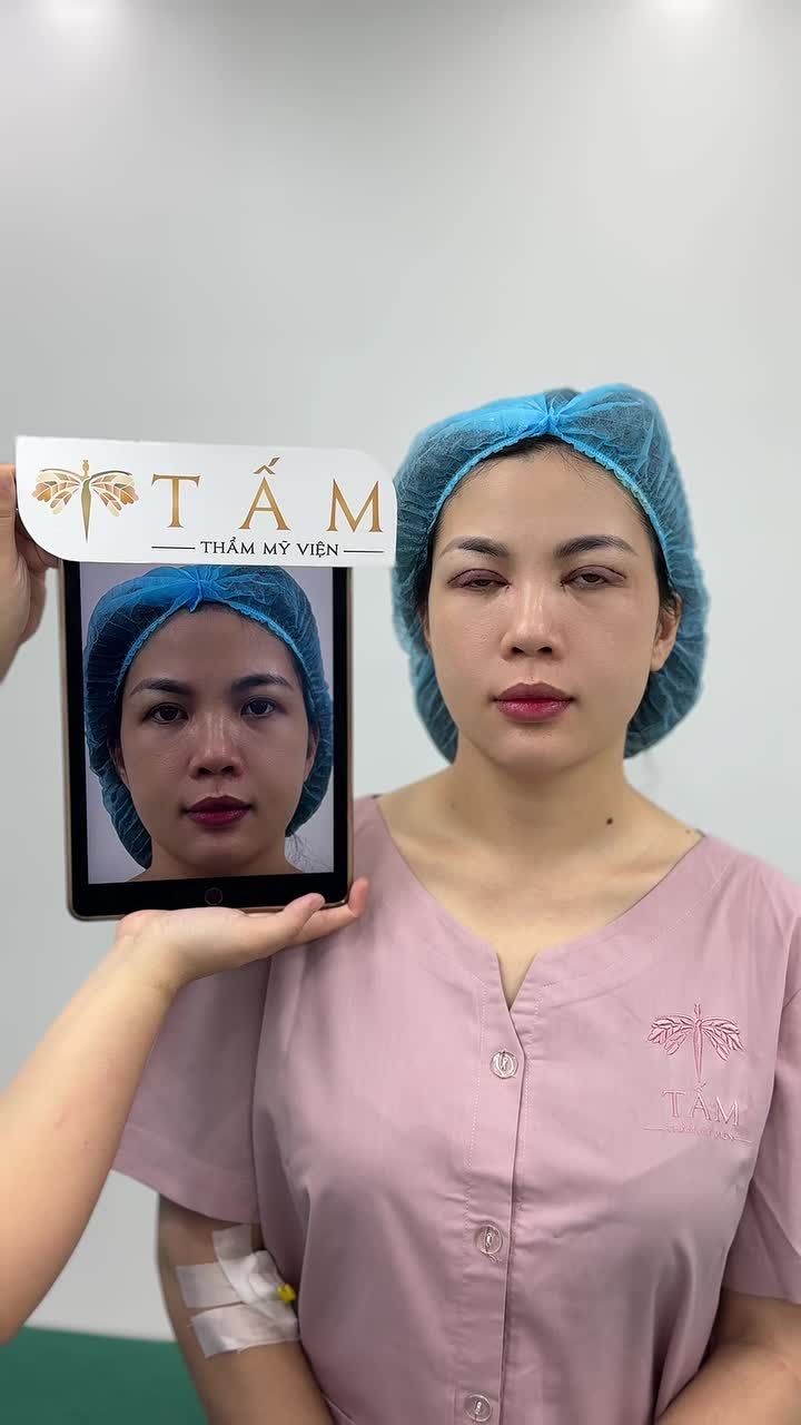 hình ảnh đôi mắt của khách hàng sau khi Cắt mí kết hợp mở góc mắt trong tại TMV Tấm.