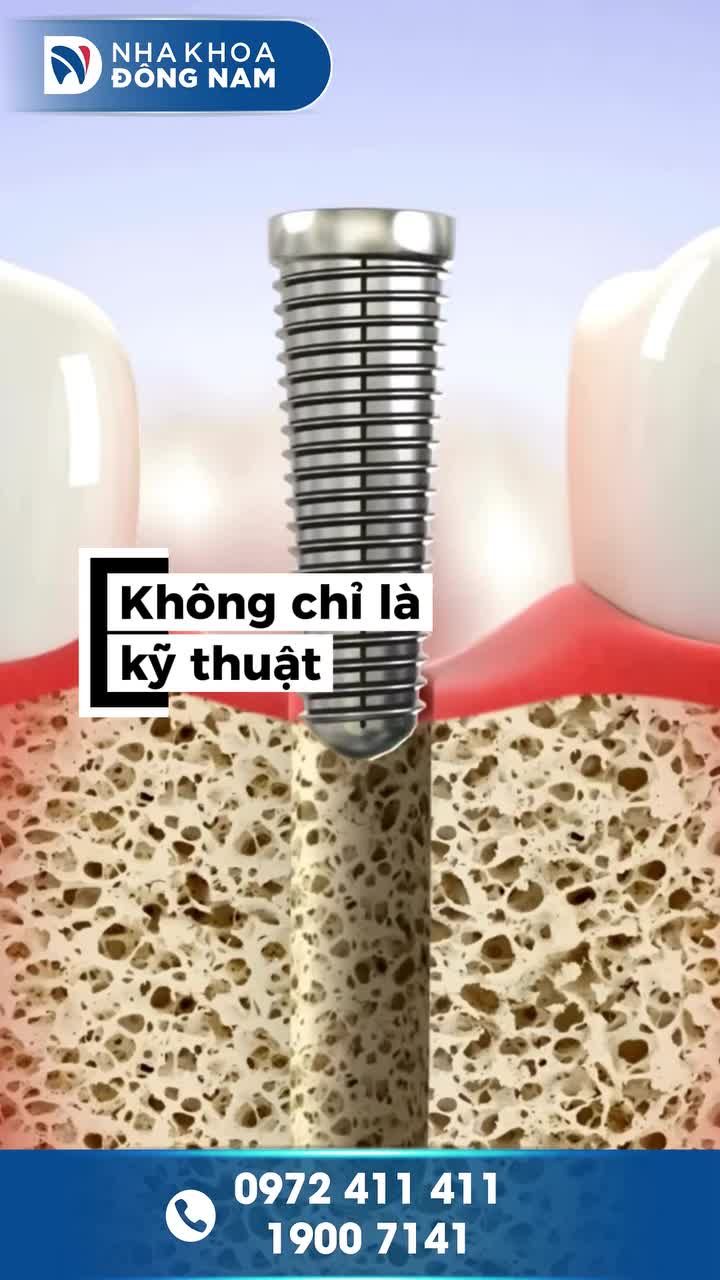 TRỒNG RĂNG IMPLANT XONG LÀ XONG? SAI LẦM KHIẾN NHIỀU NGƯỜI ĐÁNH MẤT RĂNG LẦN NỮA