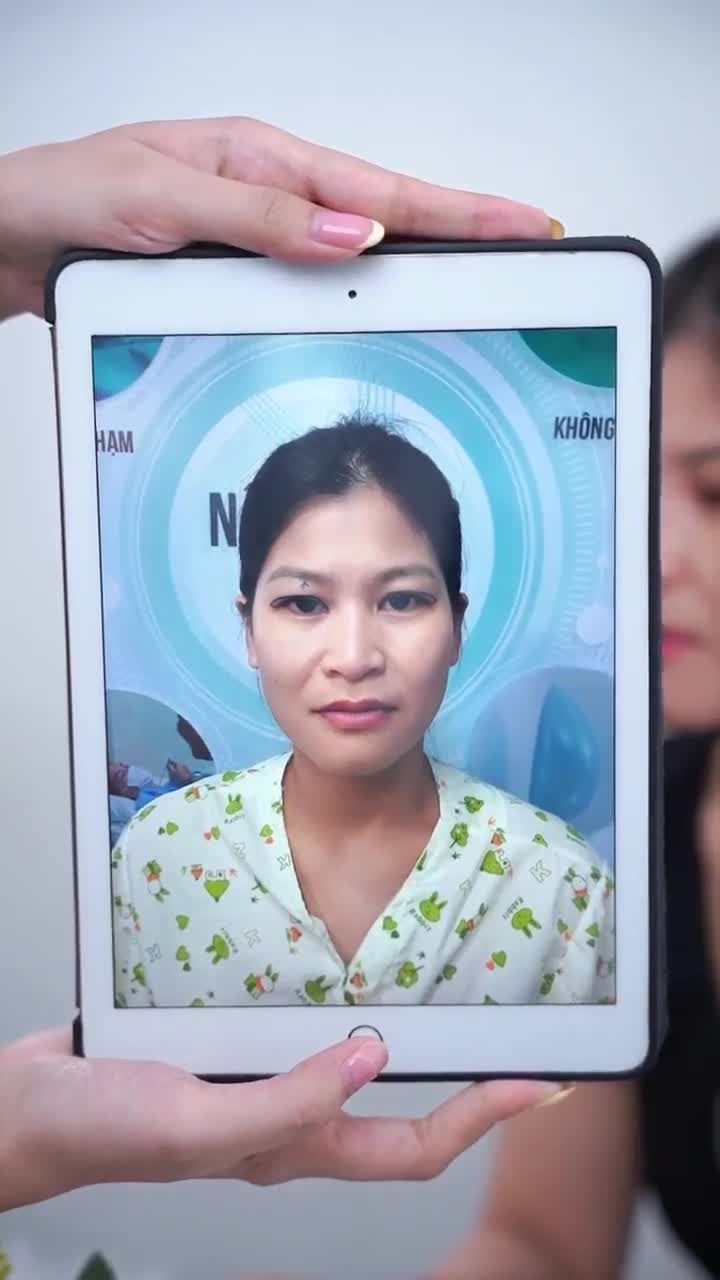 KẾT QUẢ SAU 2 TUẦN THỰC HIỆN COMBO CẮT MÍ + NÂNG MŨI KH. Ý NHI (VIỆT KIỀU ÚC)