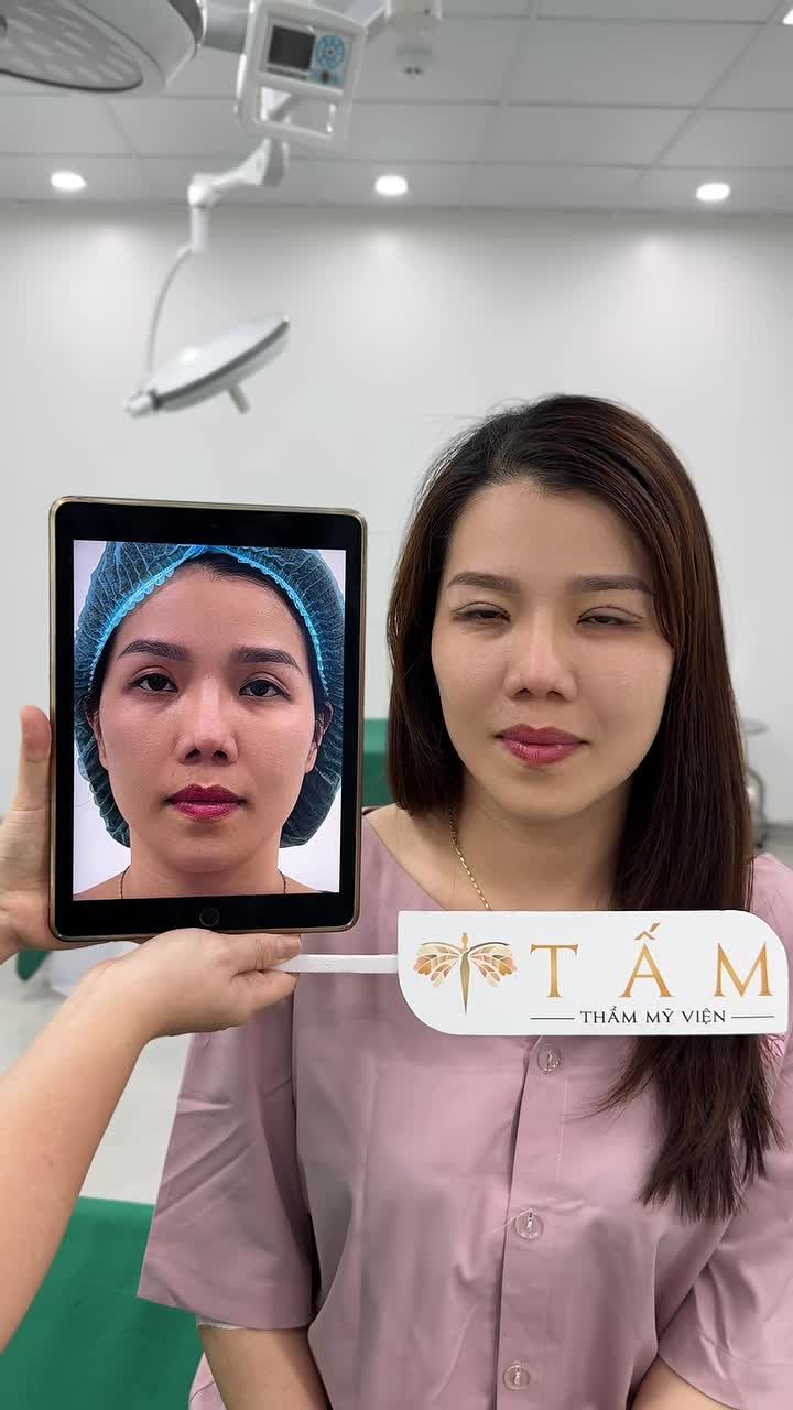 Hình ảnh chị khách hàng đến từ Yên Bái vô cùng hài lòng sau khi thực hiện Combo Cắt mí  kết hợp Hạ size và ghép mỡ.