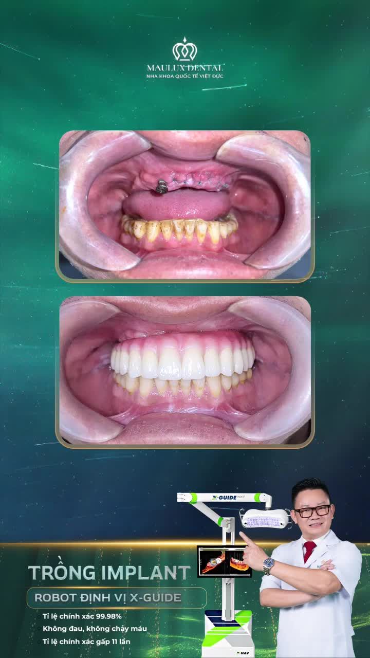 Anh Trần Văn Thắng lấy lại phong độ sau trồng răng