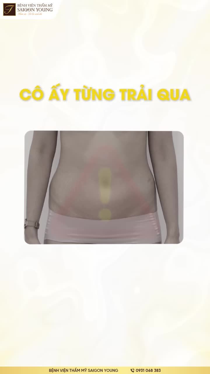 Khách chưa đầy 40 gặp trường hợp vòng bụng tích m-ỡ, da chùng nhão và lộ rõ "ngấn" khiến tổng thể vóc dáng trông nặng nề và già hơn tuổi.