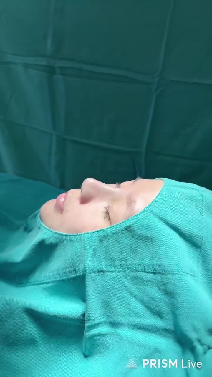 KHÁCH HÀNG VỪA NÂNG MŨI SLINE XONG