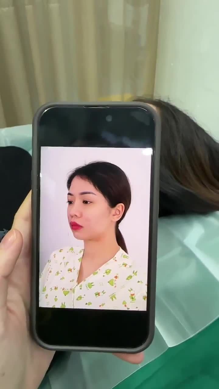 KẾT QUẢ SAU 10 NGÀY NÂNG MŨI CẤU TRÚC - SỬA LẠI MŨI HỎNG | KH. NGỌC TRANG