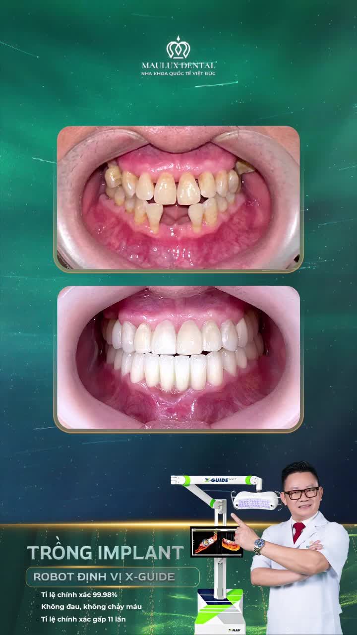 Chú Nguyễn Ái Nghĩa thay đổi thế nào sau trồng răng