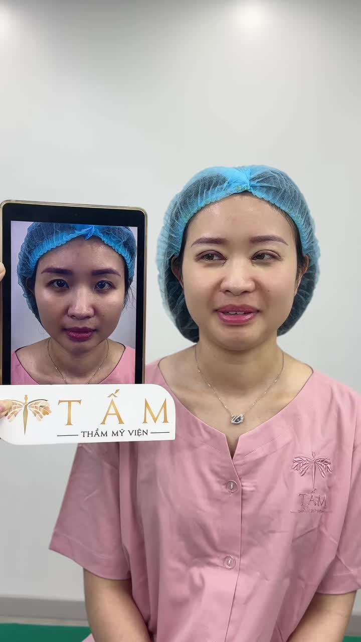 Cùng xem trực tiếp kết quả sau 45 phút của khách hàng làm Combo Cắt mí kết hợp Mở góc trong tại TMV Tấm.
