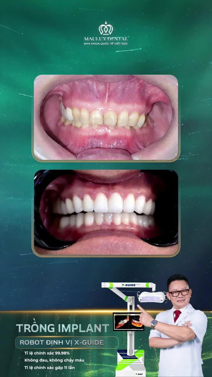 Anh Nguyễn Mạnh Tuấn lấy lại phong độ sau cấy implant và bọc răng sứ