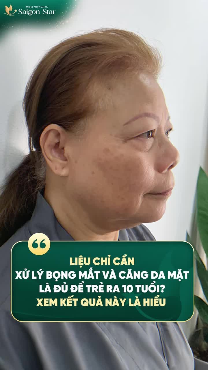 KHÁCH HÀNG SAIGON STAR TRẺ RA 10 TUỔI NGAY SAU KHI CĂNG DA MẶT VÀ XỬ LÝ BỌNG MẮT!!!