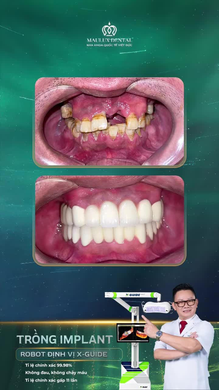 Mất răng, tiêu xương nhiều, chú Nguyễn Văn Điệp thay đổi thế nào sau trồng răng