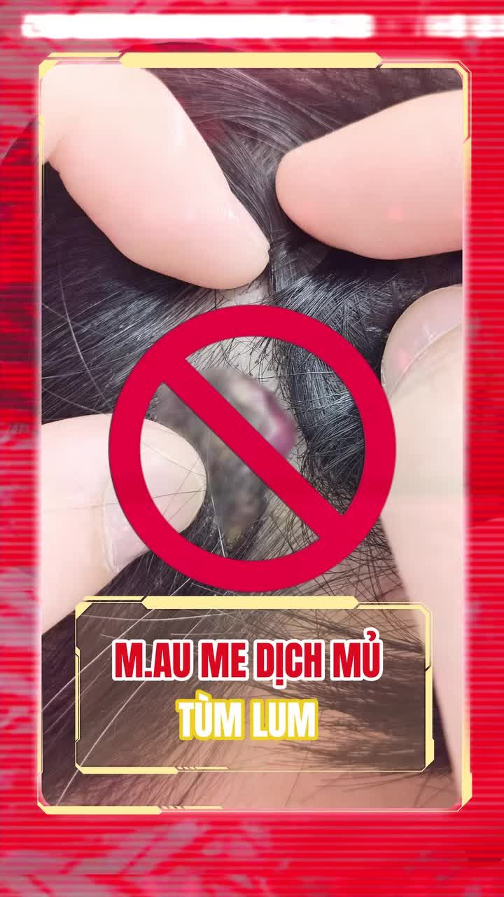 TỤ DỊCH DO ĐỘN THÁI DƯƠNG LỖI