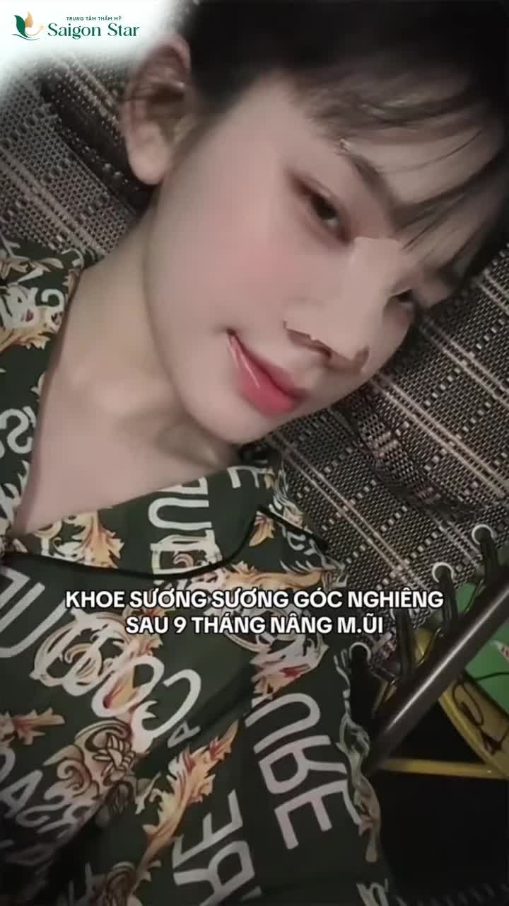 KHOE SƯƠNG SƯƠNG VỚI CẢ NHÀ GÓC NGHIÊNG CỰC PHẨM SAU 9 THÁNG NÂNG MŨI TẠI SAIGON STAR!!!