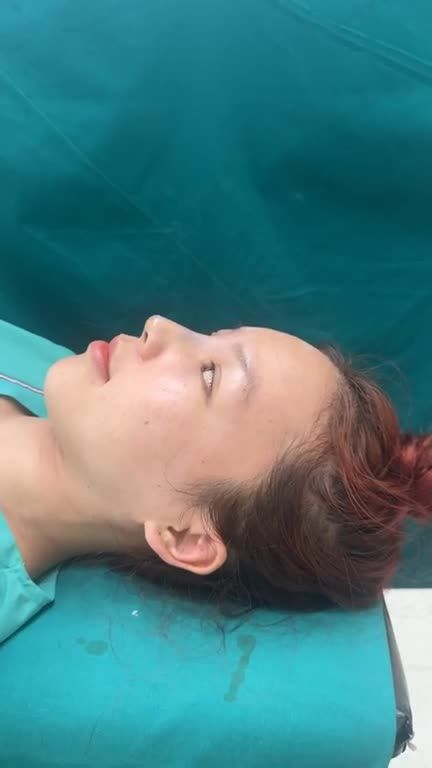 MŨI BỌC SỤN DÁNG TỰ NHIÊN SAU PHÚT!!