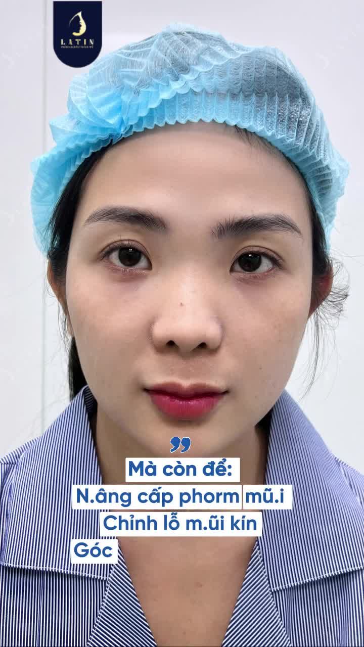 KHI SỬA MŨI KHÔNG CHỈ ĐỂ MŨI CAO HƠN
