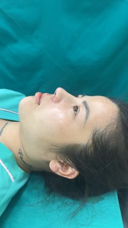 MŨI CẤU TRÚC RÚT CHỈ VỪA HOÀN THÀNH CHO BẠN GÁI ĐẾN TỪ PHÚ THỌ – DÁNG MŨI LÊN FORM XINH XUẤT SẮC