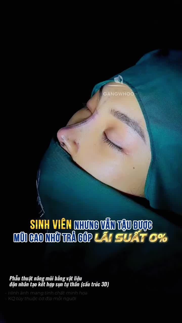 Đẹp trước thanh toán sau cùng trả góp 0%, chốt lịch nâng mũi ngay