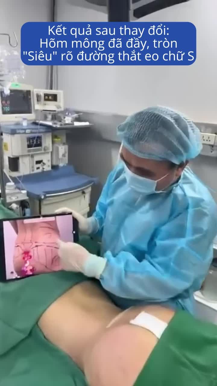 Xử trí V3 lõm sâu thành V3 tròn trịa với Dr Vương