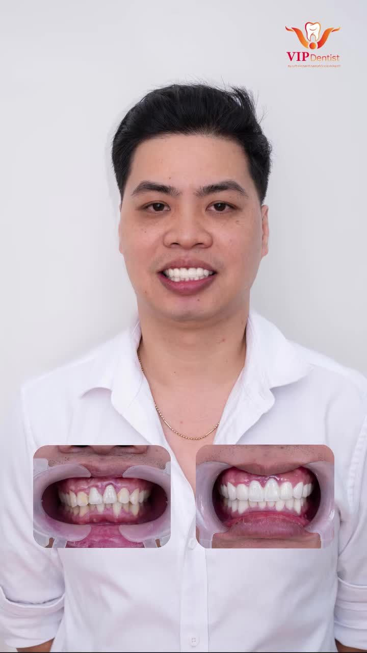 LÀM RĂNG SỨ THAY ĐỔI DIỆN MẠO NHƯ THẾ NÀO?