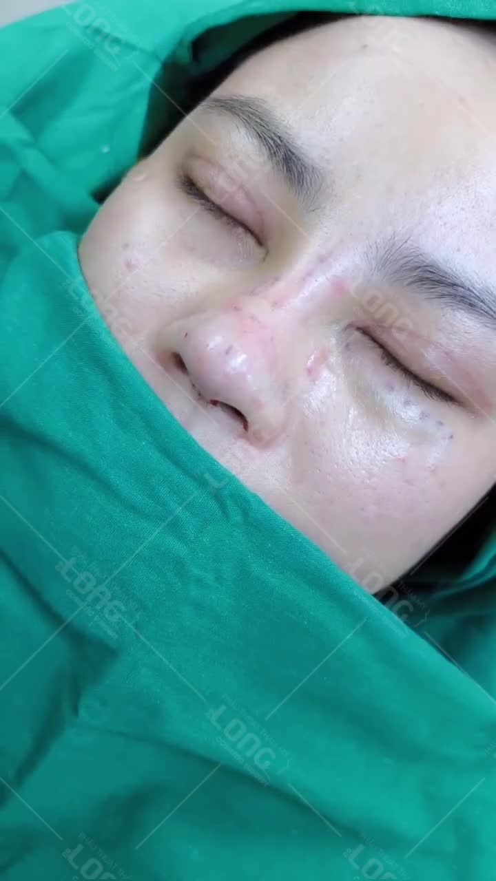 SAU KHI NÂNG MŨI LÀM NGAY ĐIỀU NÀY TẠI NHÀ.